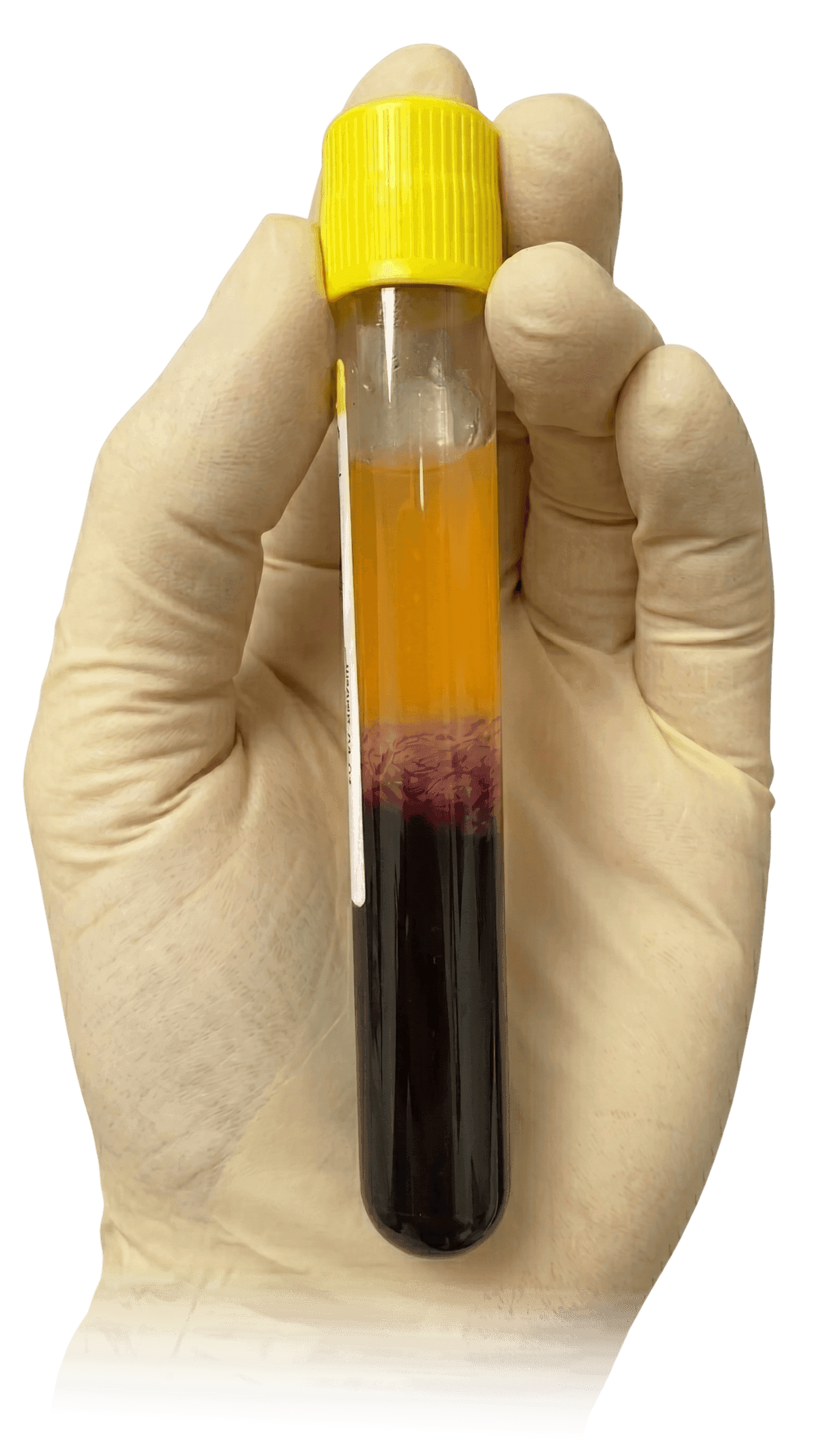 Selphyl PRP tube held in hand showing separated platelet-rich plasma